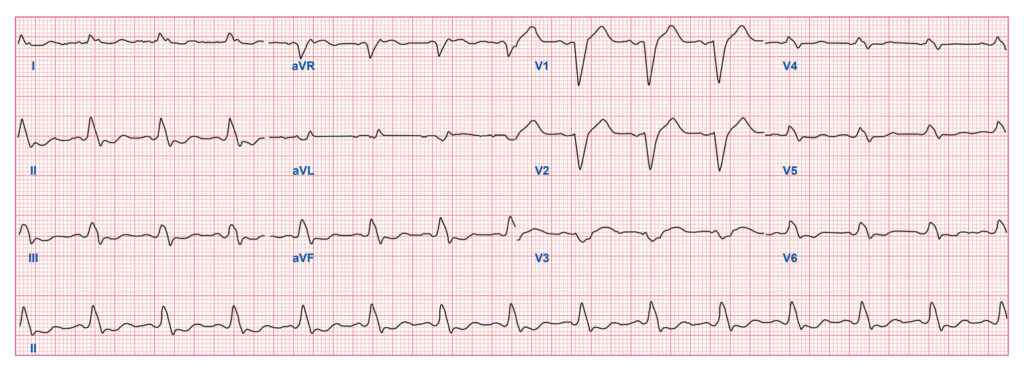 Quiz Part 2 Morphological Abnormalities - ECG Simplified