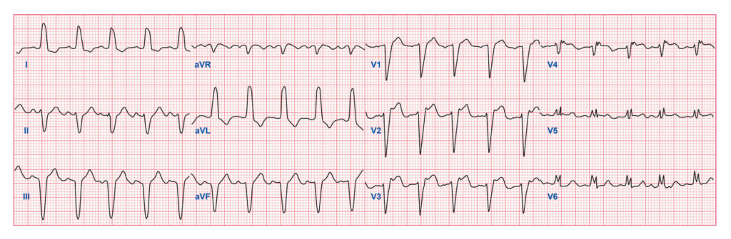 Quiz Part 2 Morphological Abnormalities - ECG Simplified