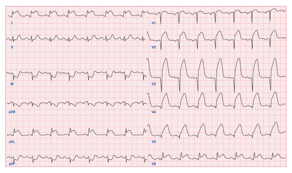 Quiz Part 2 Morphological Abnormalities - ECG Simplified