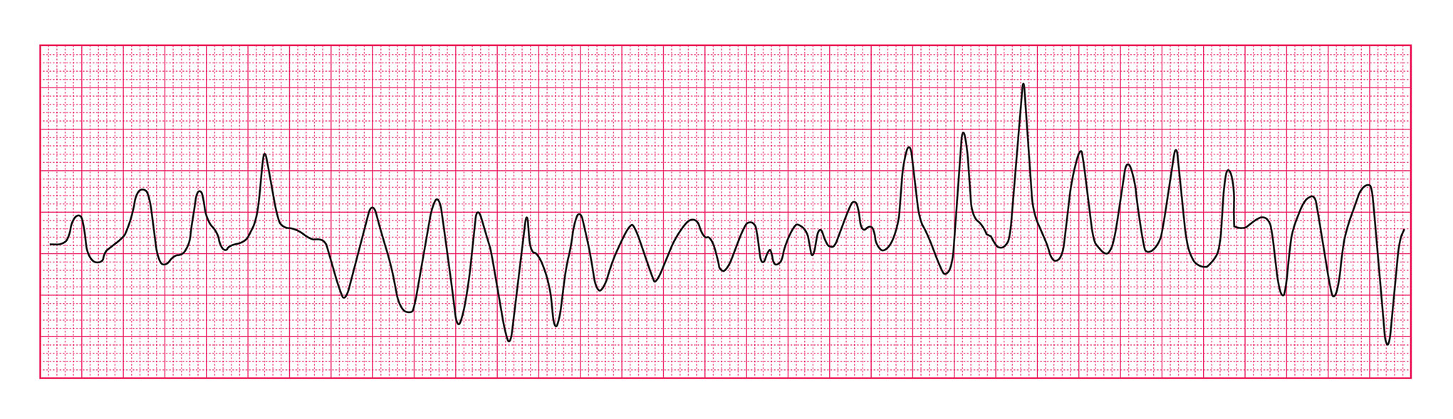 Quiz Part 3 Rhythm Disturbances - ECG Simplified