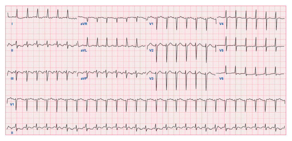 Quiz Part 3 Rhythm Disturbances - ECG Simplified