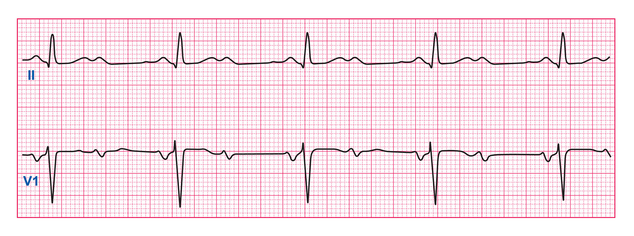 Quiz Part 3 Rhythm Disturbances - ECG Simplified