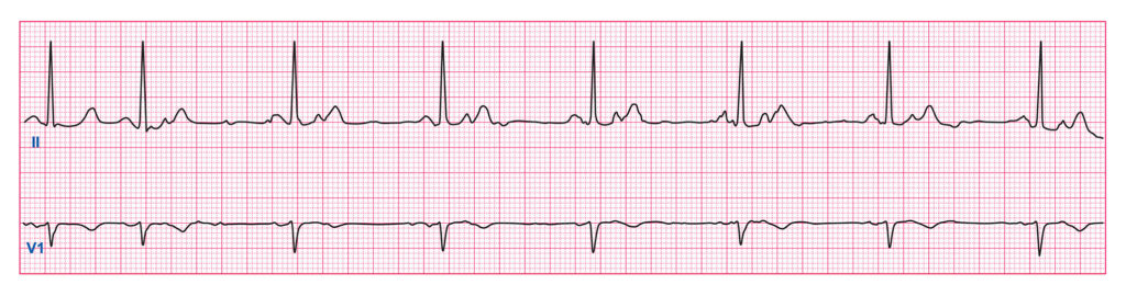 Quiz Part 3 Rhythm Disturbances - ECG Simplified