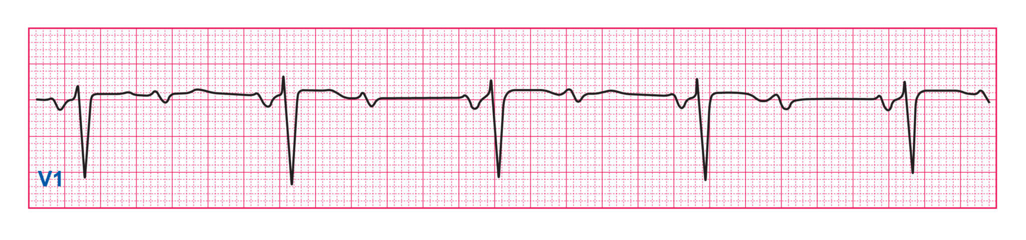 Quiz Part 1 The Basics - ECG Simplified