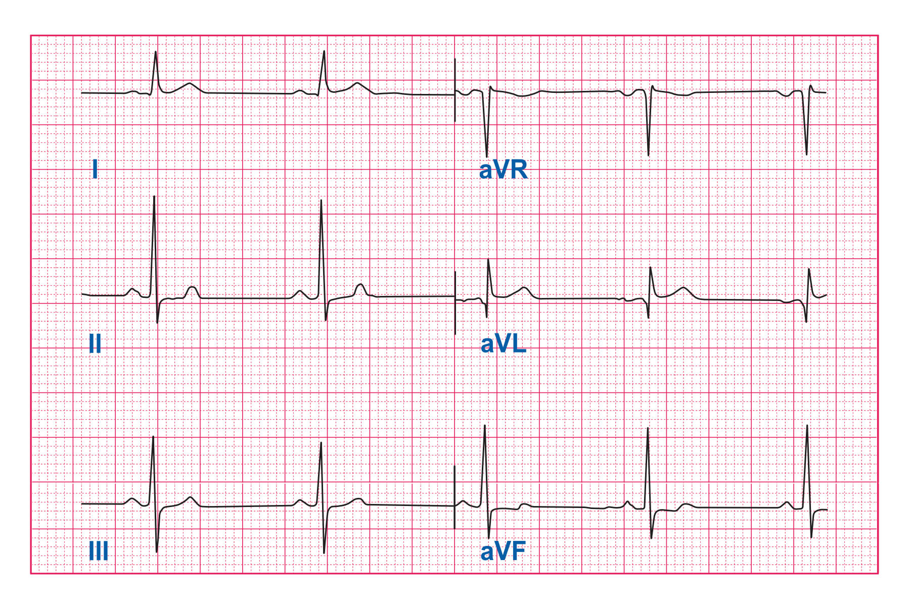 Quiz Part 1 The Basics - ECG Simplified